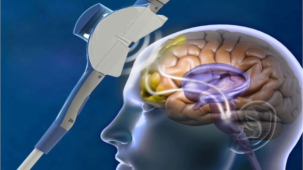 TMS TMS Understanding Transcranial Magnetic Stimulation (TMS) for Depression: A Comprehensive Guide